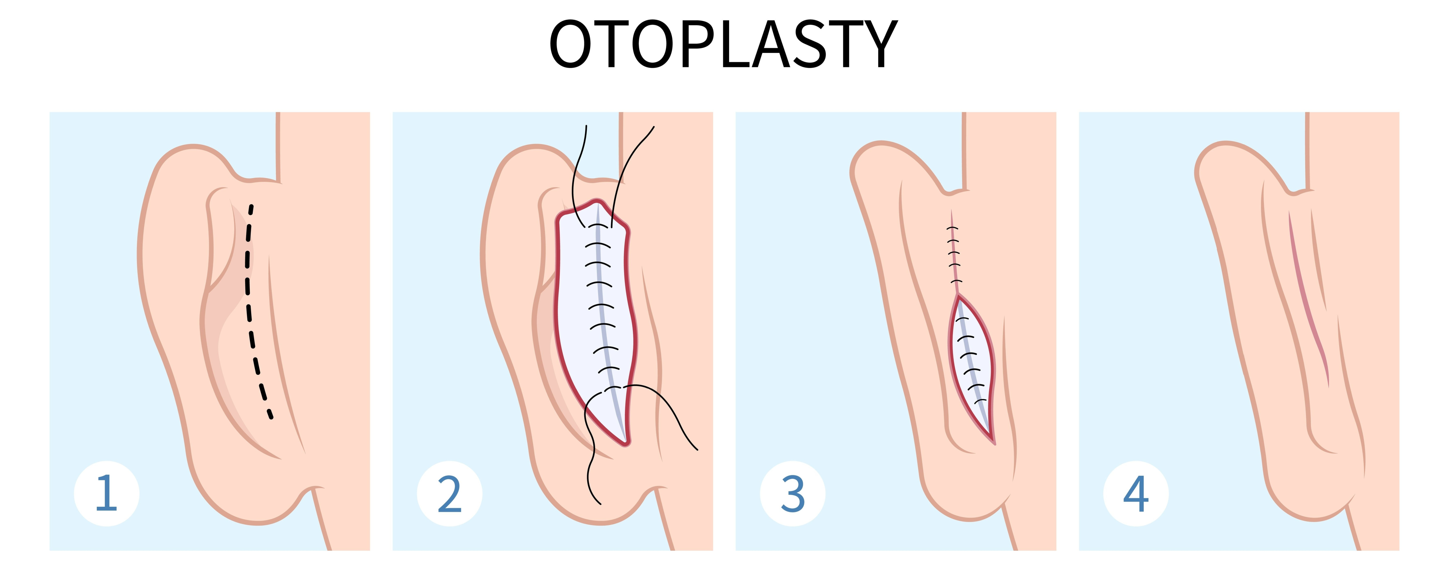 steps of otoplasty surgery