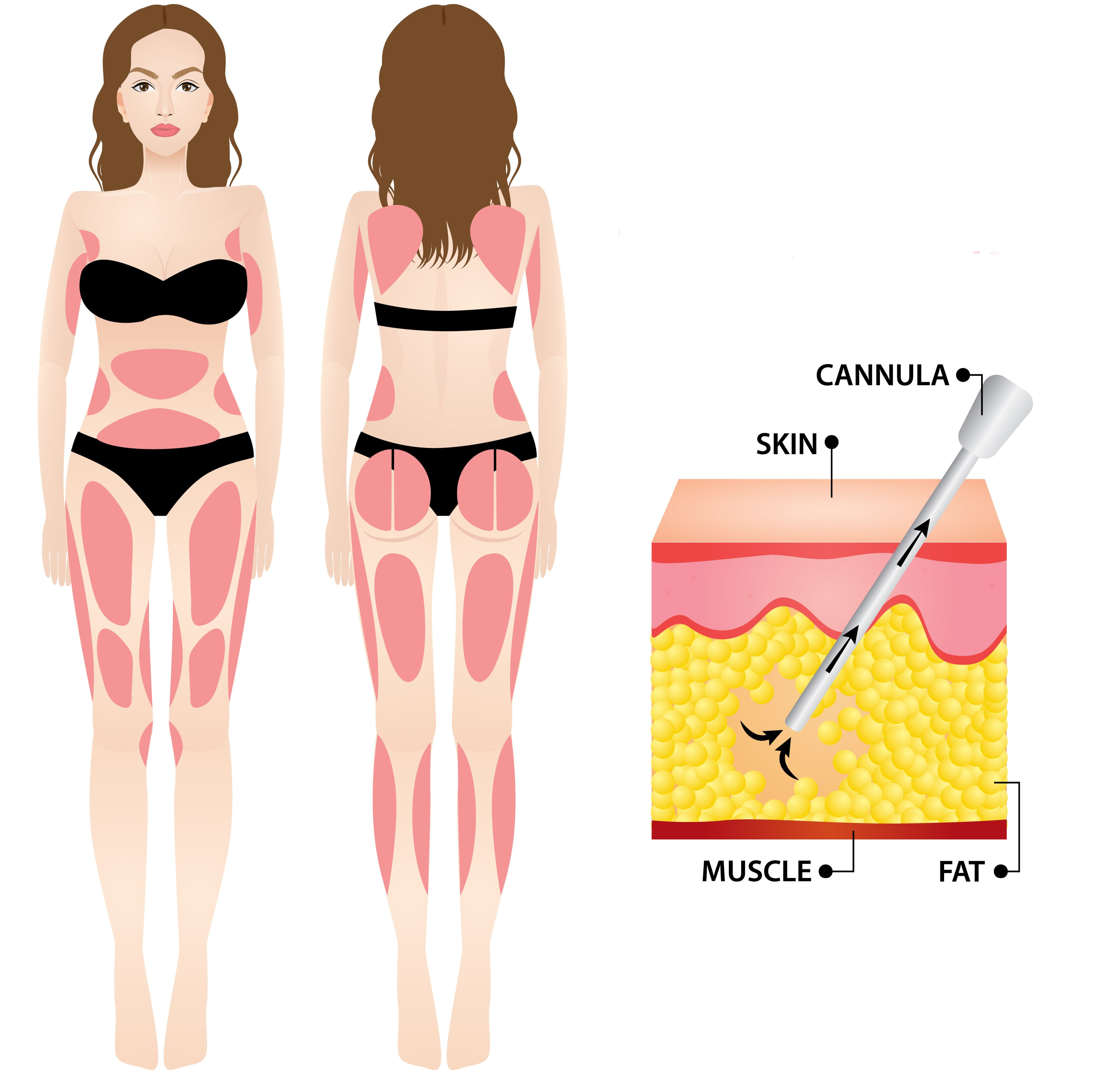illustration of liposuction zones and the fat