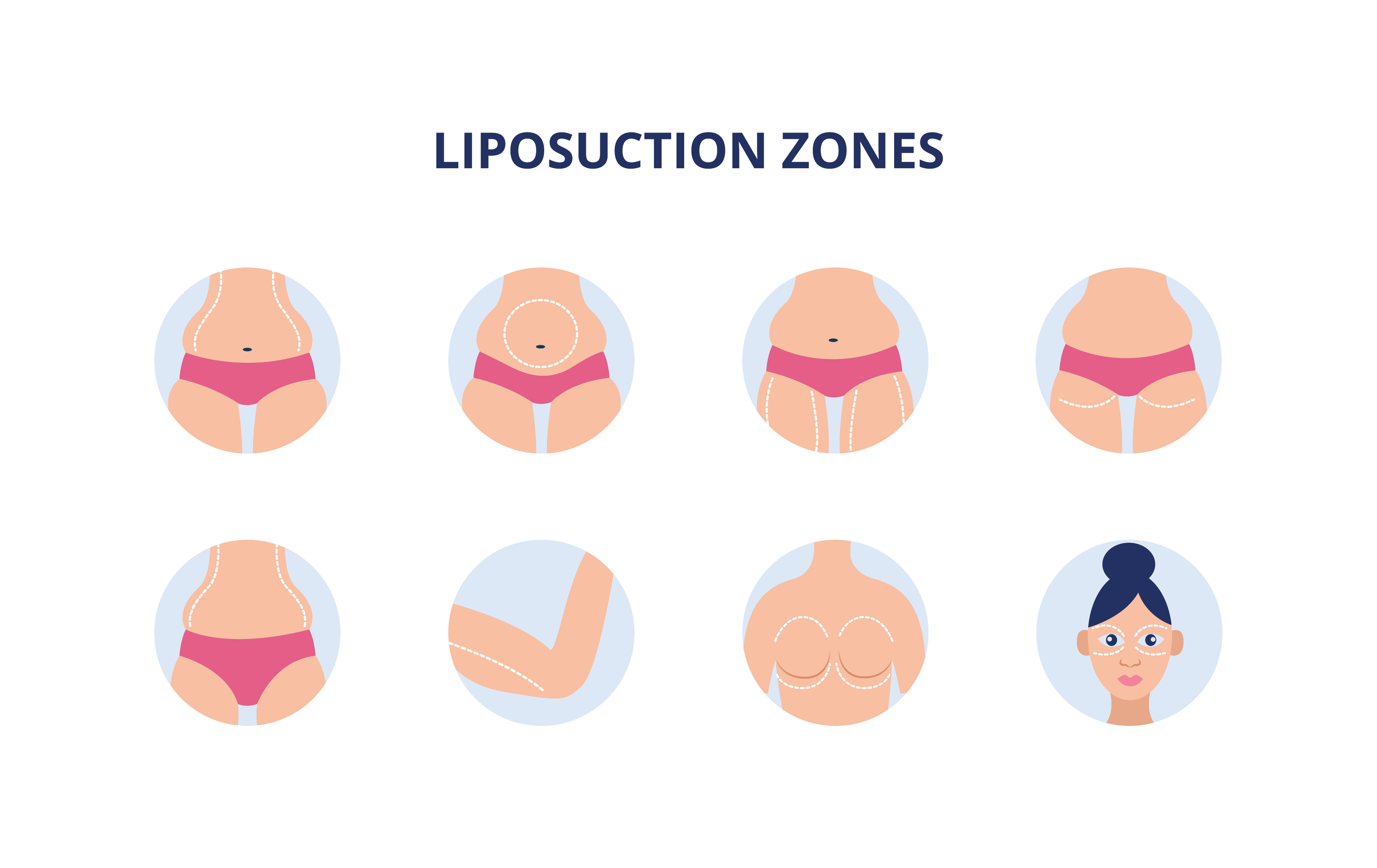 liposuction zones in body