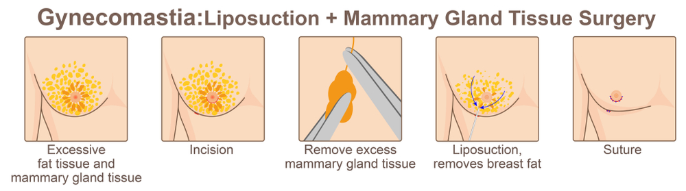 steps of gynecomastia surgery