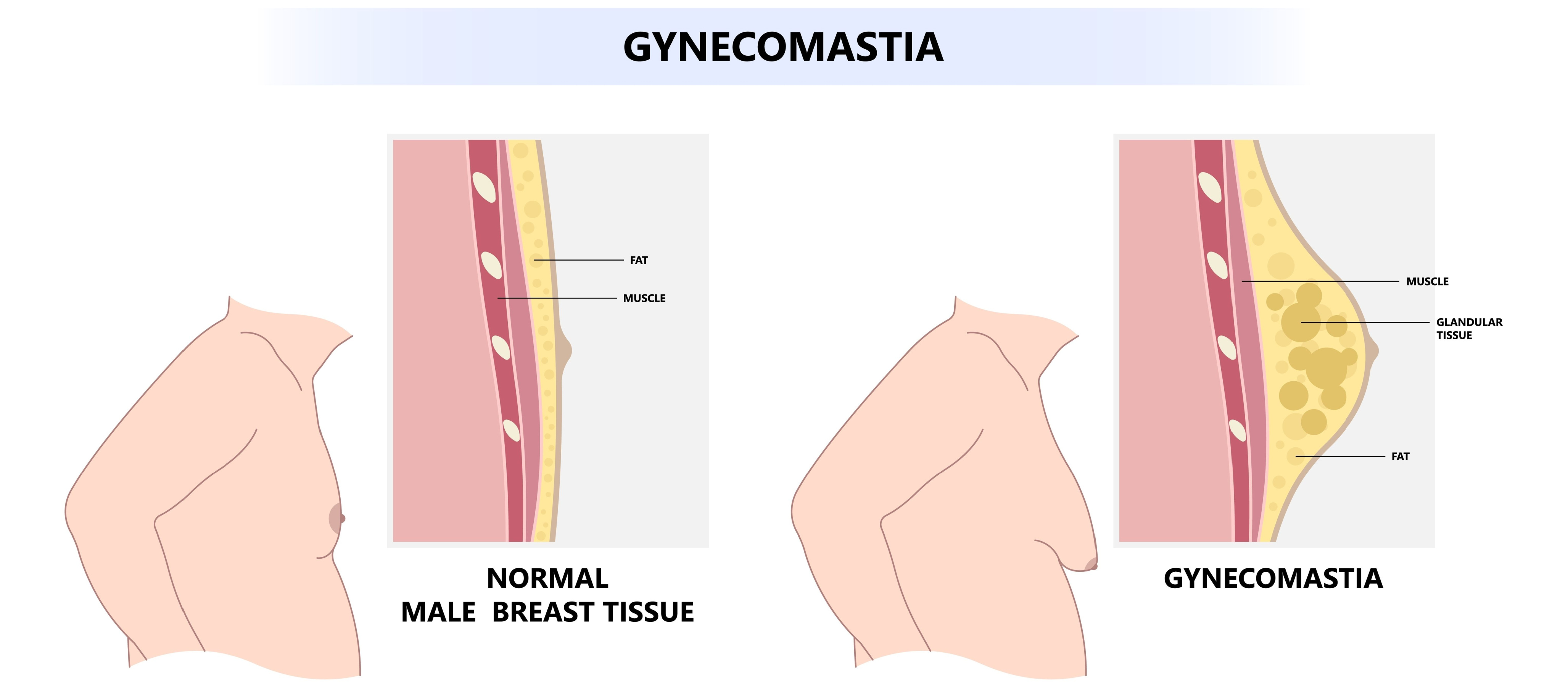 normal male chest and gynecomastia