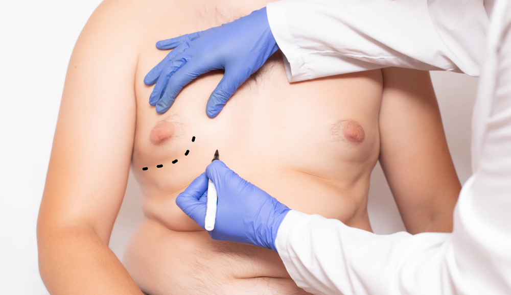 gynecomastia surgery examination marking