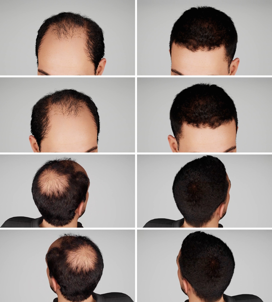 hair transplant results from different angles