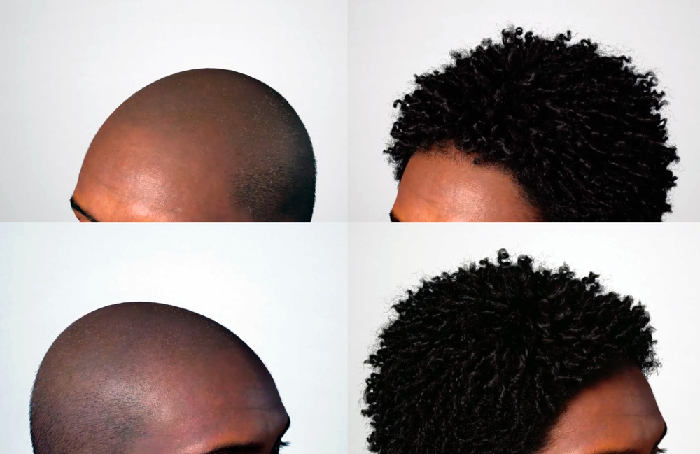 afro hair transplant before after