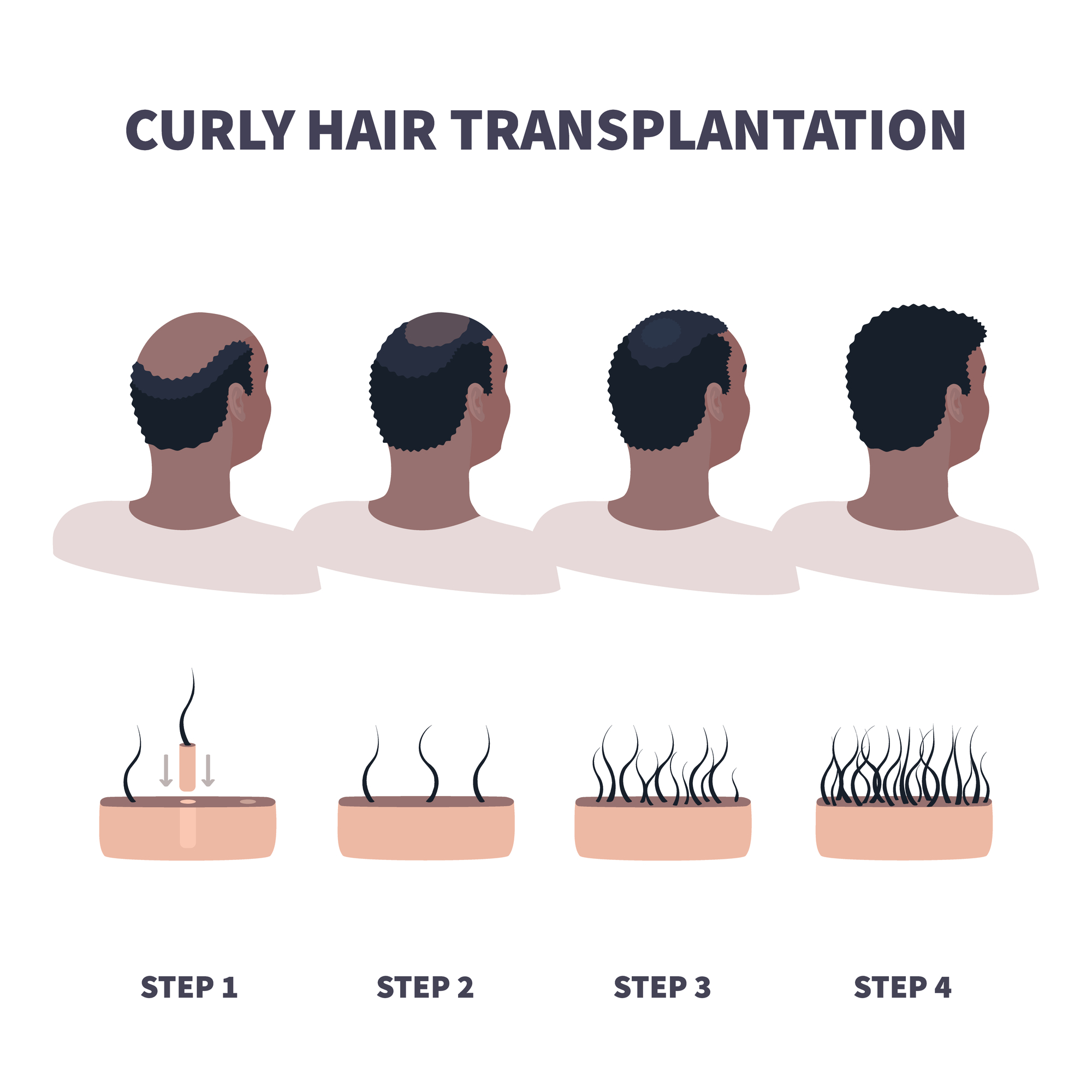curly hair transplantation illustration
