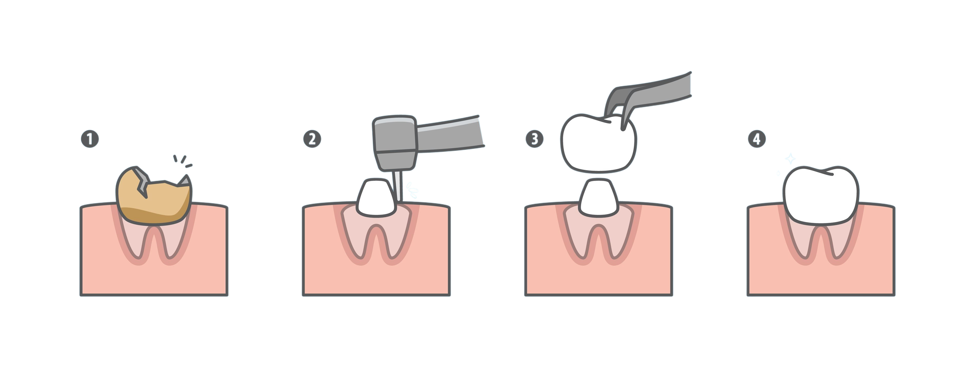 steps of dental crown procedure