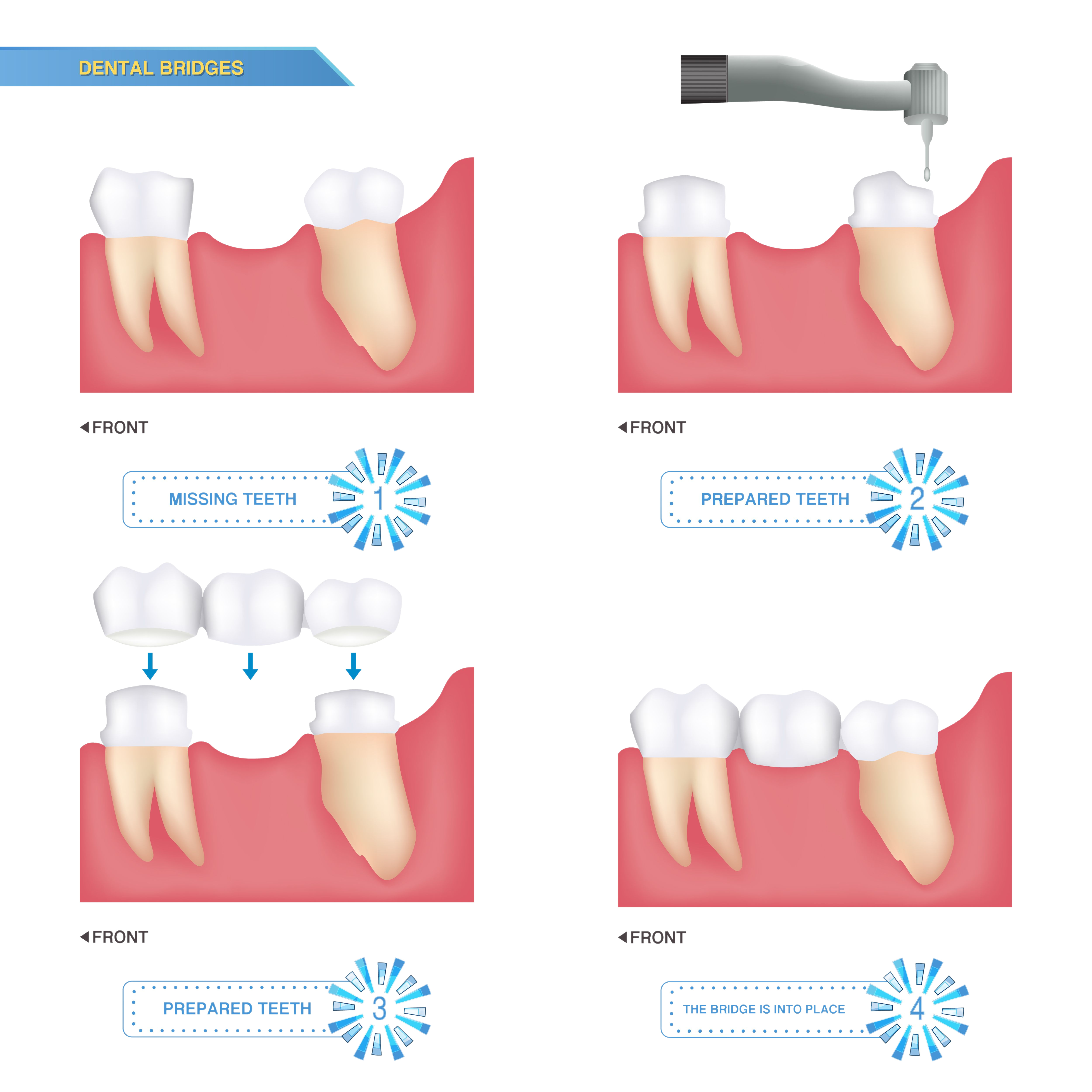 dental bridge procedure illustration