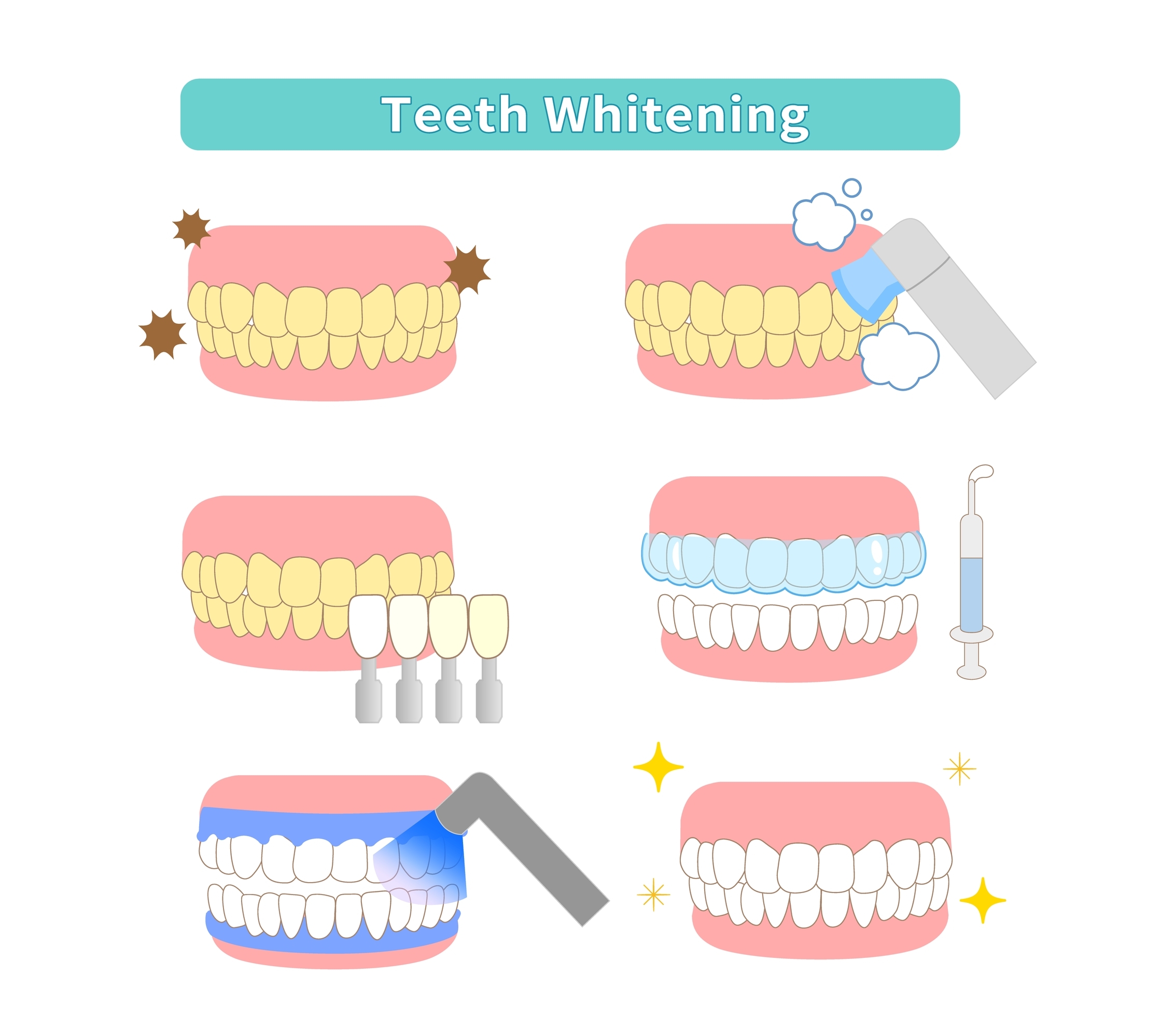 steps of teeth whitening procedure