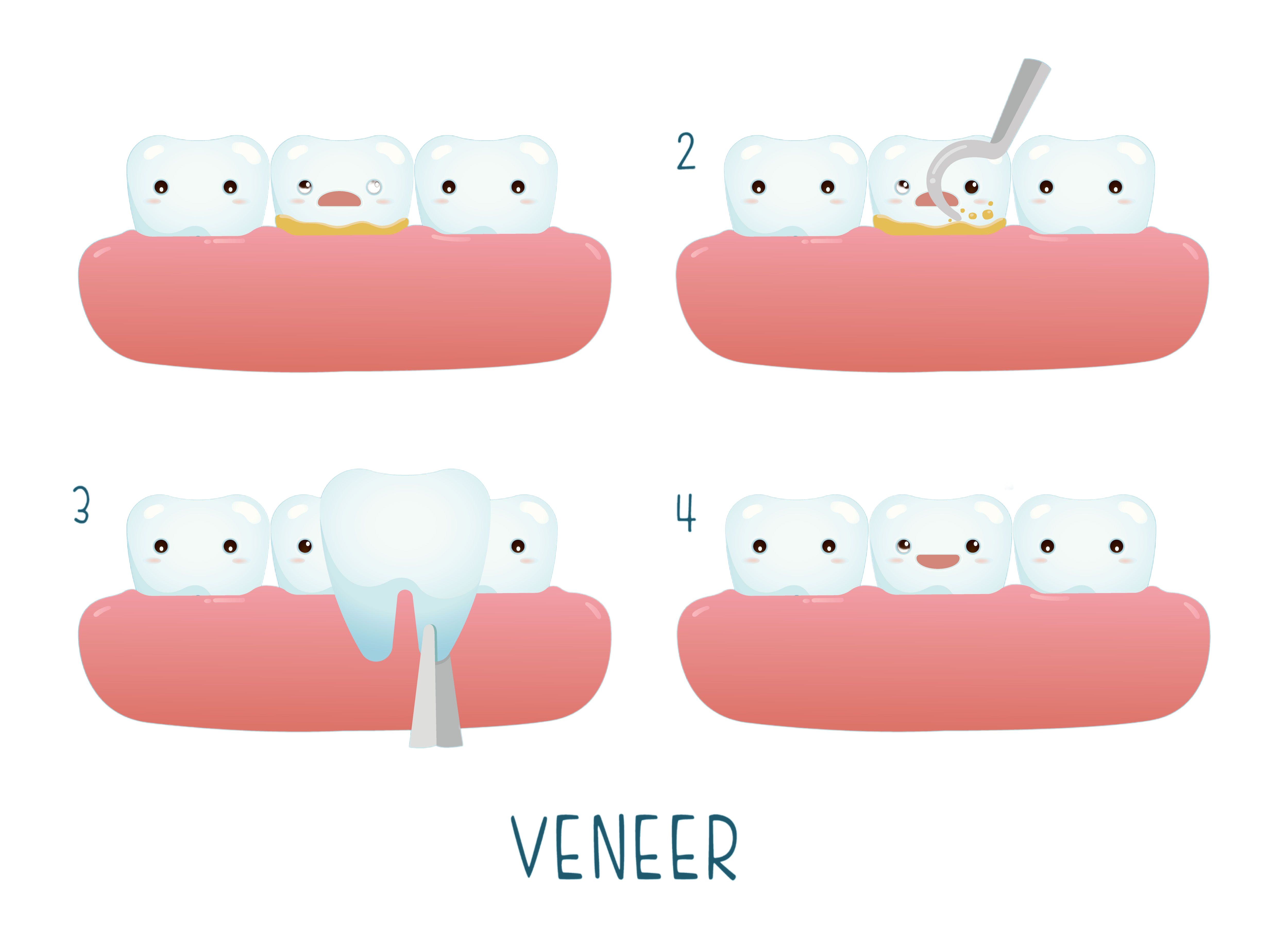 steps of dental veneer procedure