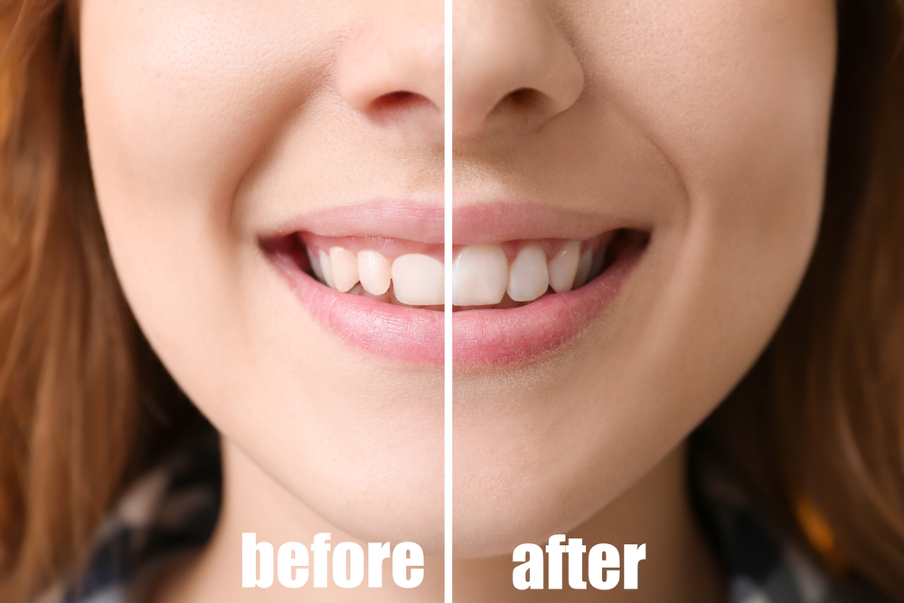 gum contouring before after