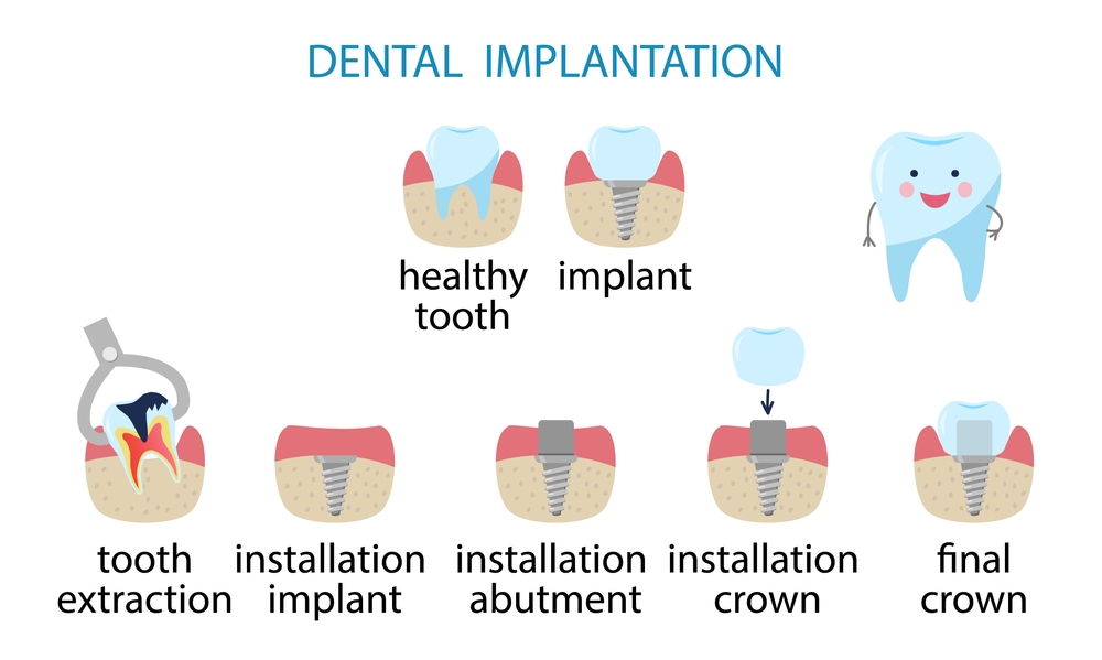 dental implant procedure steps