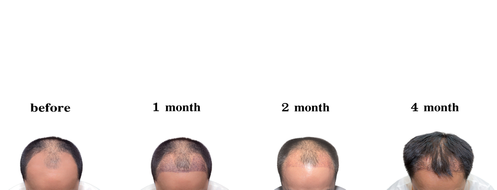 hair transplant results first 4 months