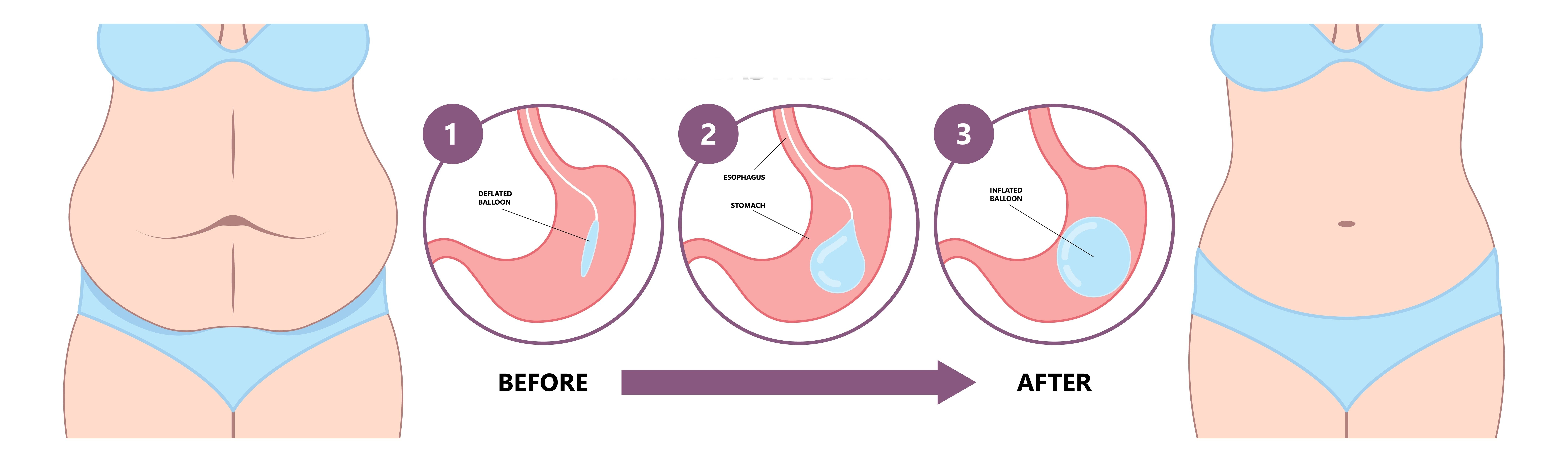 how gastric balloon procedure is done