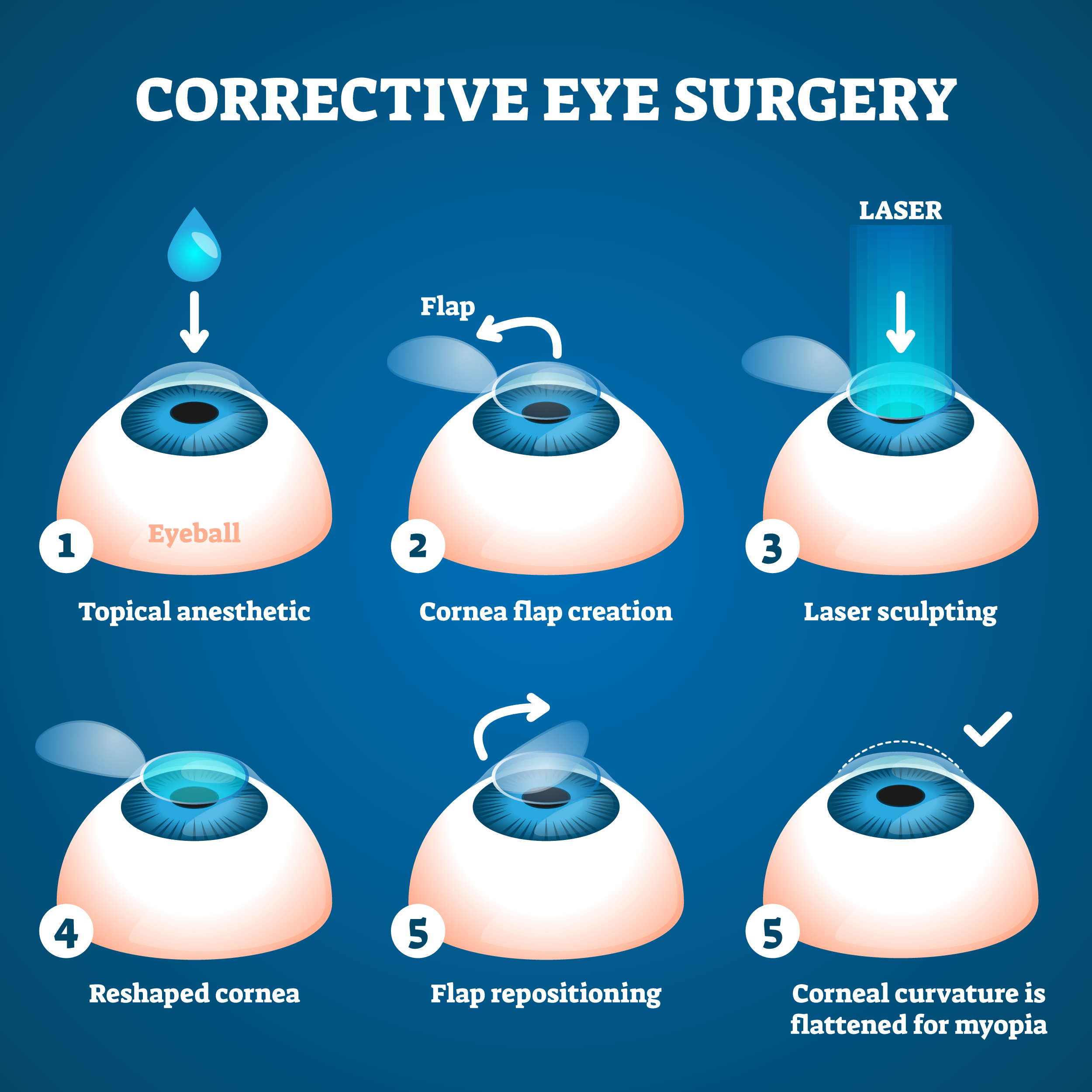how lasik eye surgery is performed