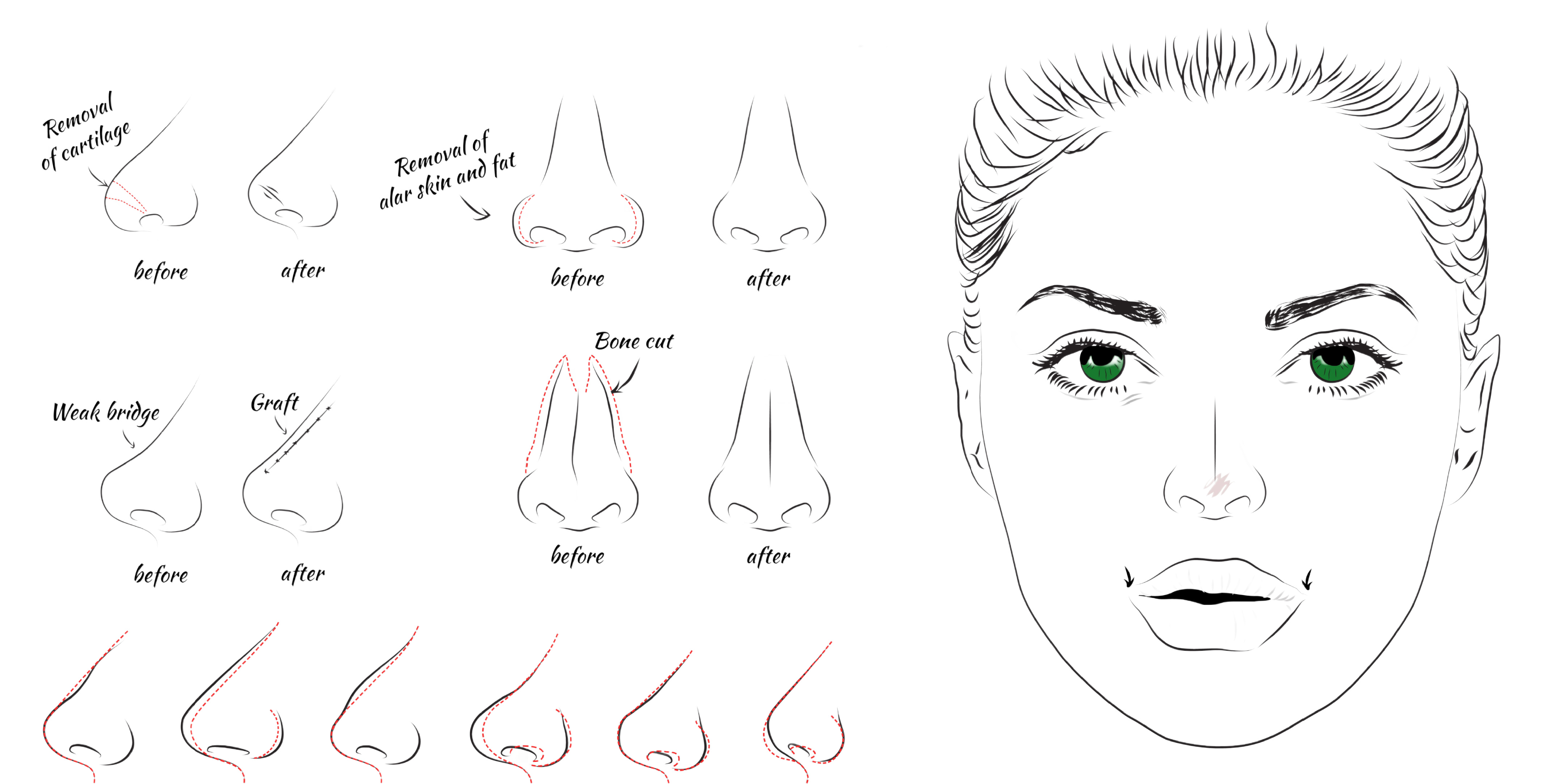 results of different nose job approaches