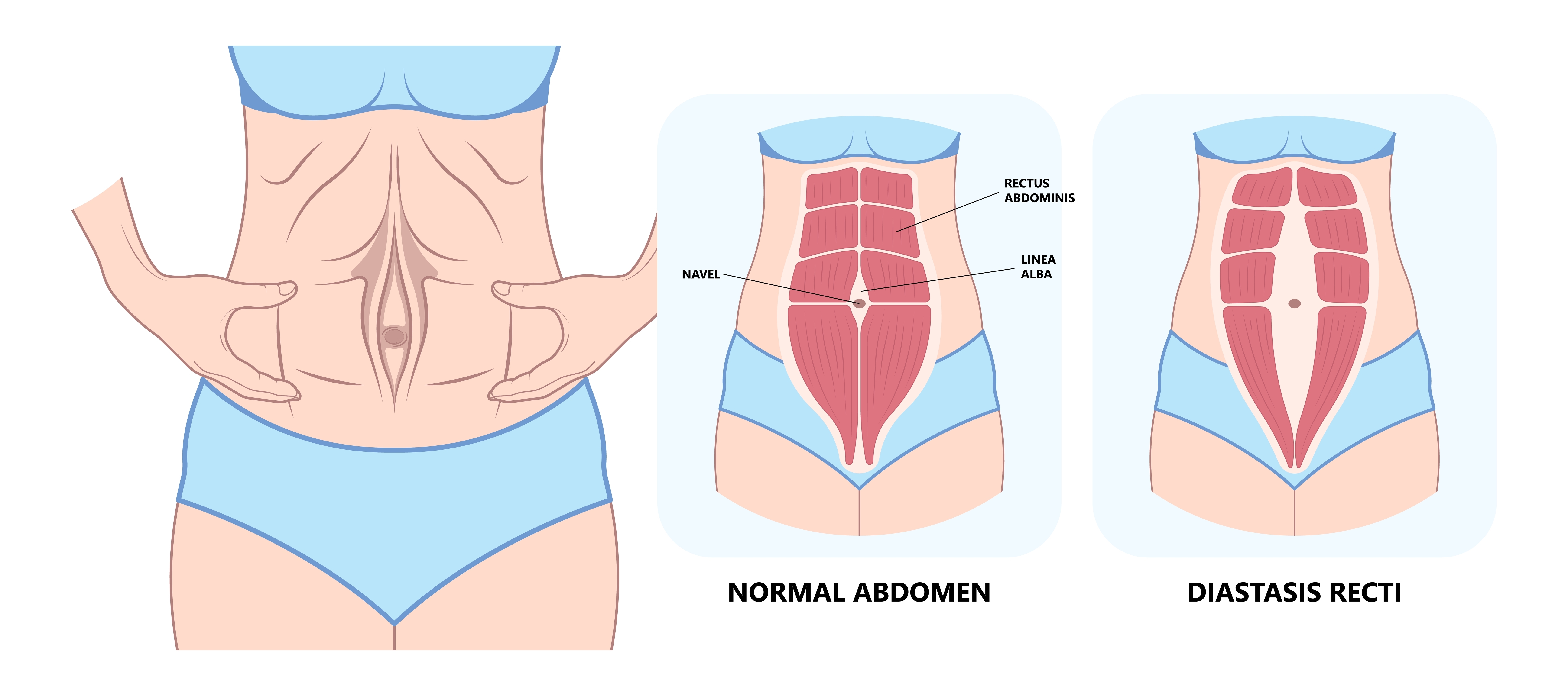 normal abdomen and diastasis recti