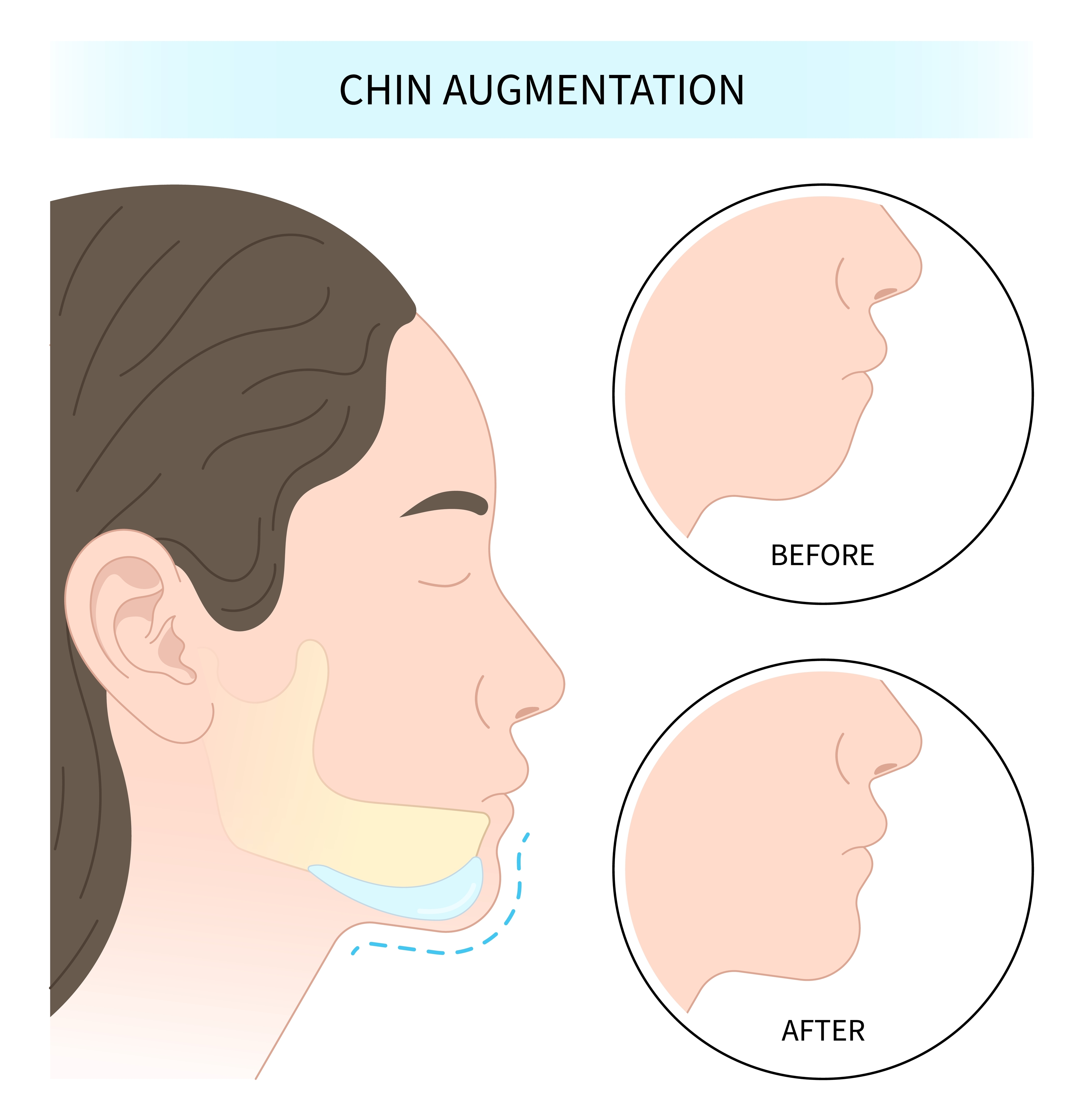 chin augmentation before after