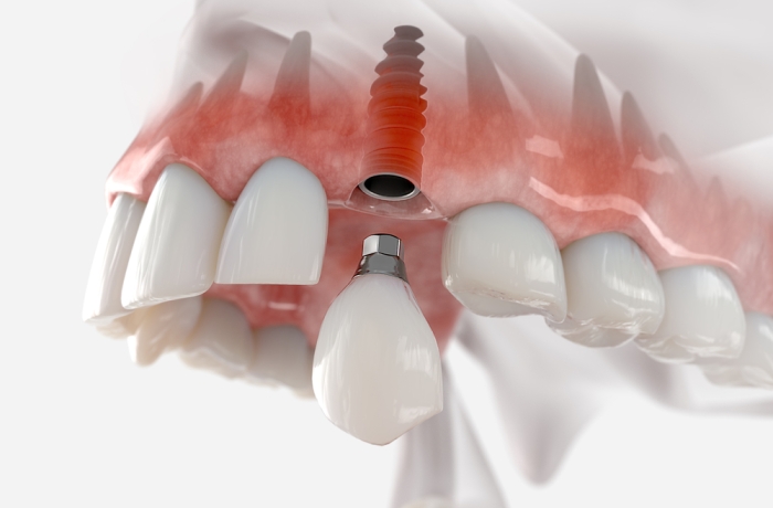 einzelnes Zahnimplantat im Oberkiefer